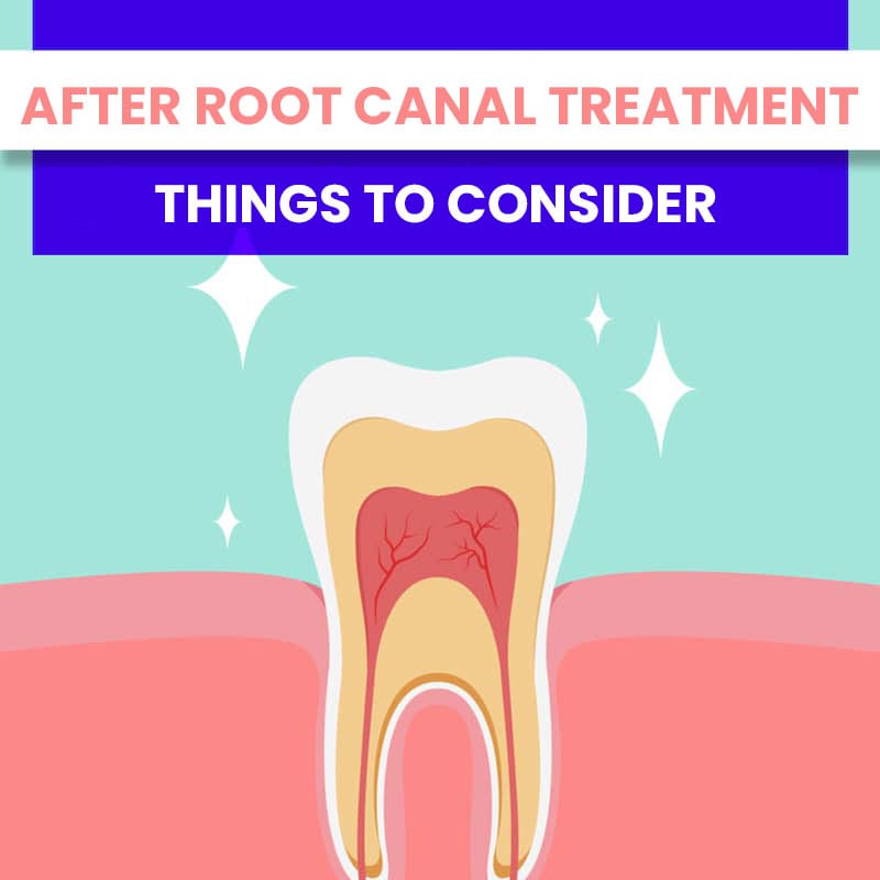 After Root Canal Treatment