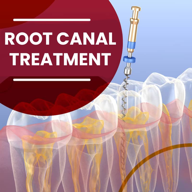 Root Canal Treatment
