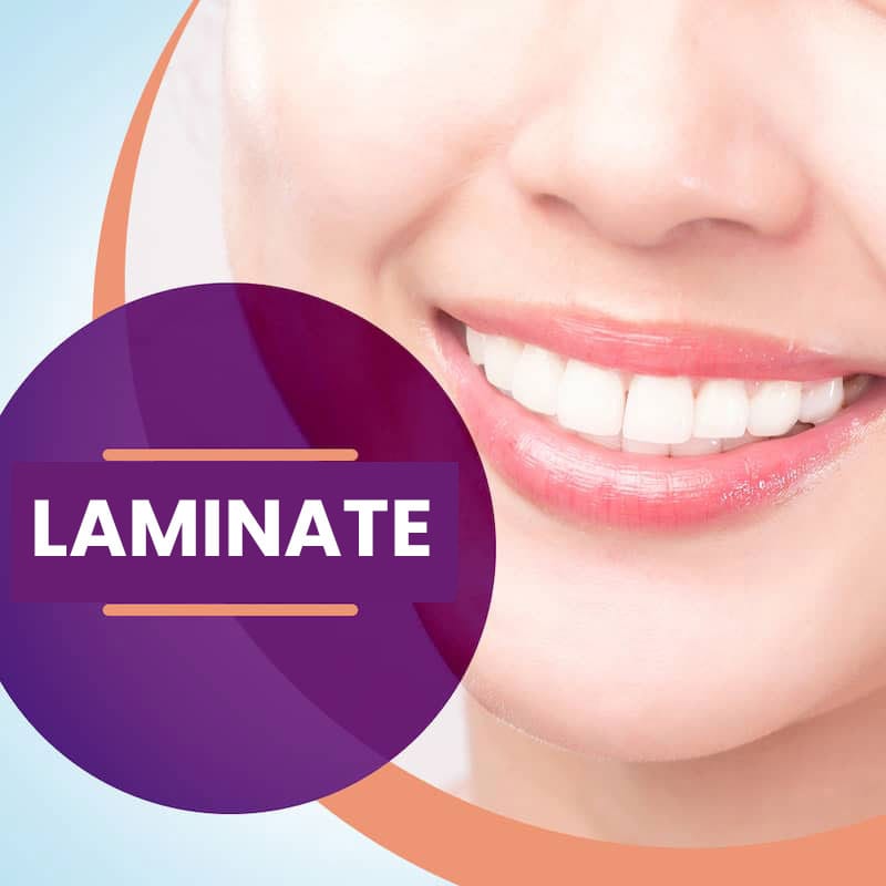 How is laminate veneer applied