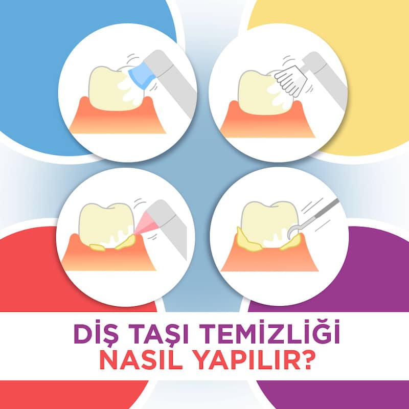 Diş taşı temizletme yaşamkent