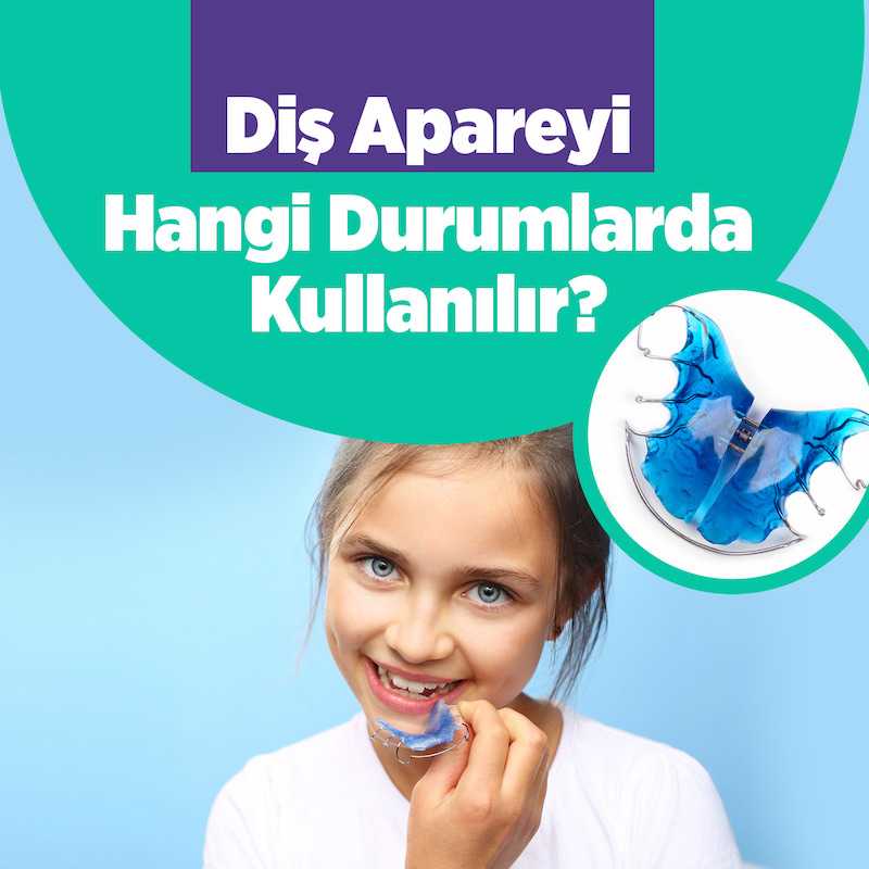 Diş apareyi nasıl yapılır